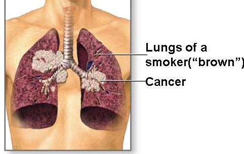 Lung Cancer